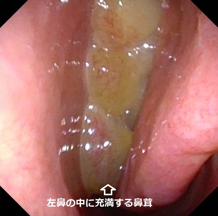 好酸球性副鼻腔炎とは